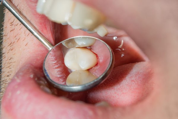 Tooth Decay Treatment Moorooka