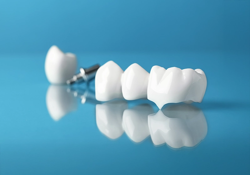 Dental Bridges