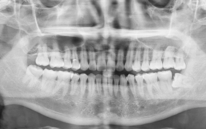 Wisdom Teeth Extraction Xray