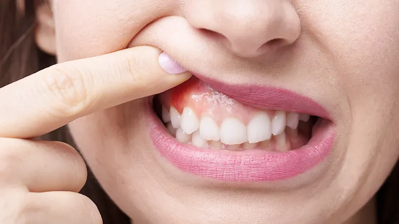 Swelling of the gums Swelling of the gums