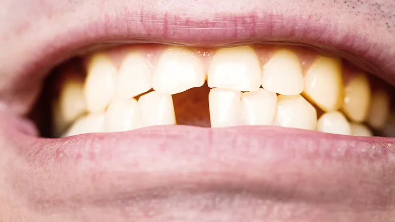 dislodged tooth dislodged tooth