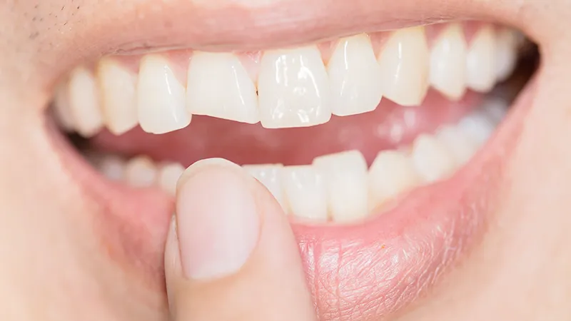 Broken or chipped tooth Broken or chipped tooth