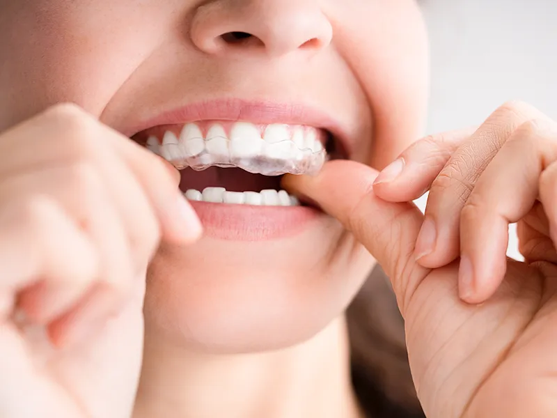 Clear Aligner