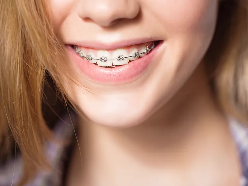 Braces
