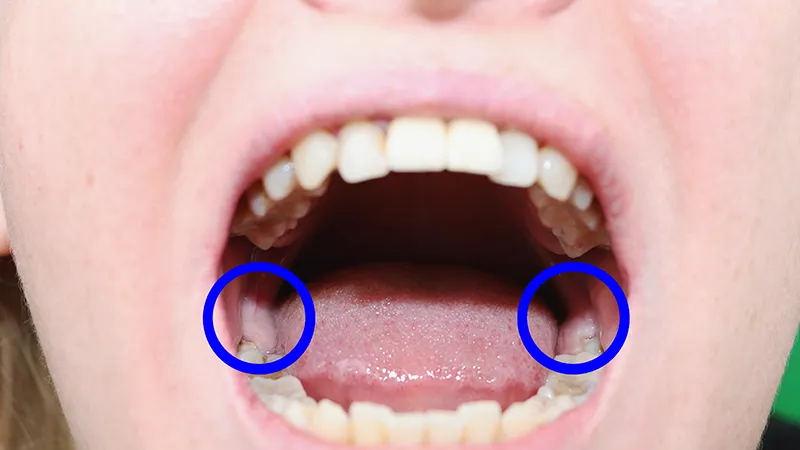 Wisdom teeth removal