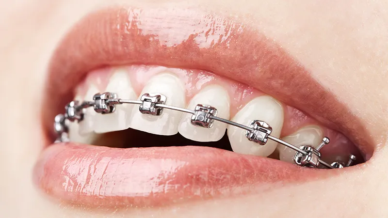 Metal braces