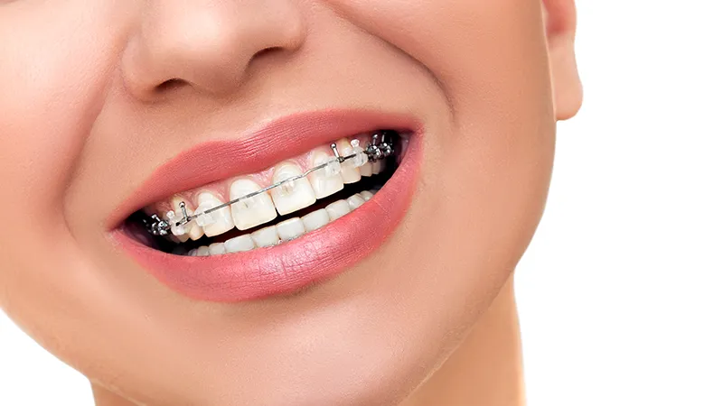 Ceramic braces