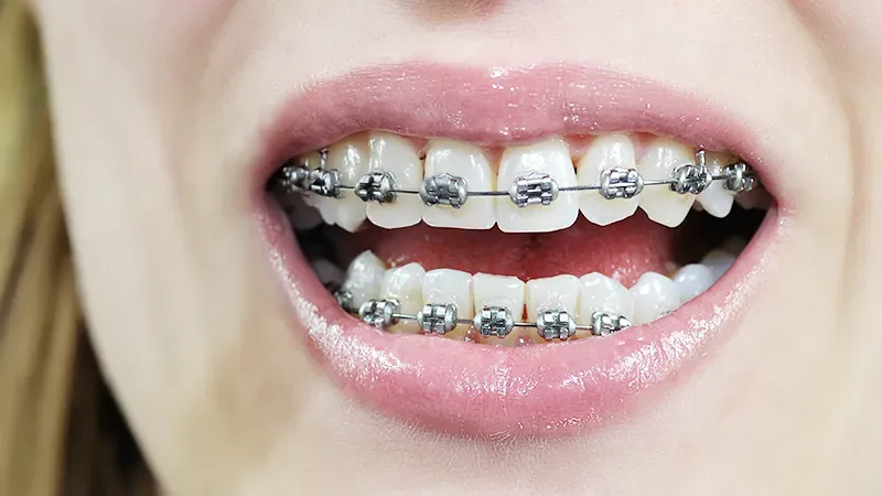 loose braces loose braces