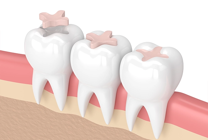 Rock-solid second chances with dental crowns